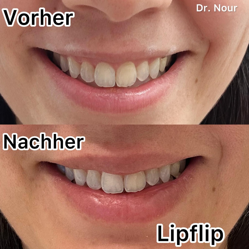 Vorher Nachher — Lipflip, Dr. Nour