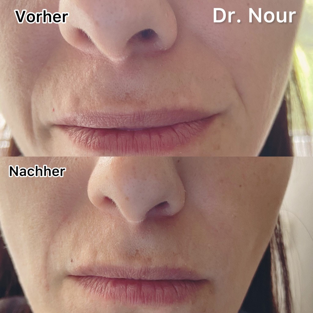 Vorher Nachher — Lippen & Falten, Dr. Nour