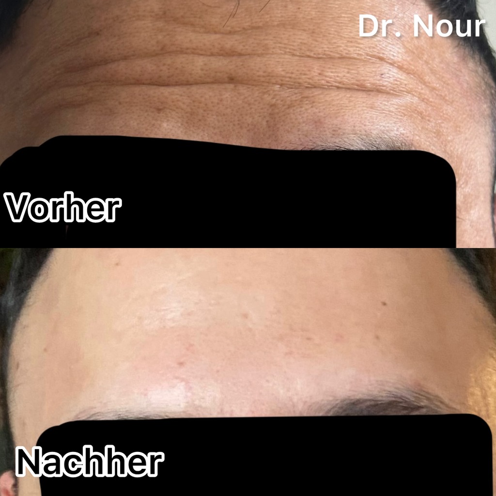 Vorher Nachher — Stirnfalten, Dr. Nour