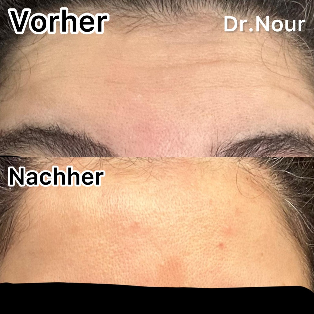 Vorher Nachher — Stirnfalten, Dr. Nour