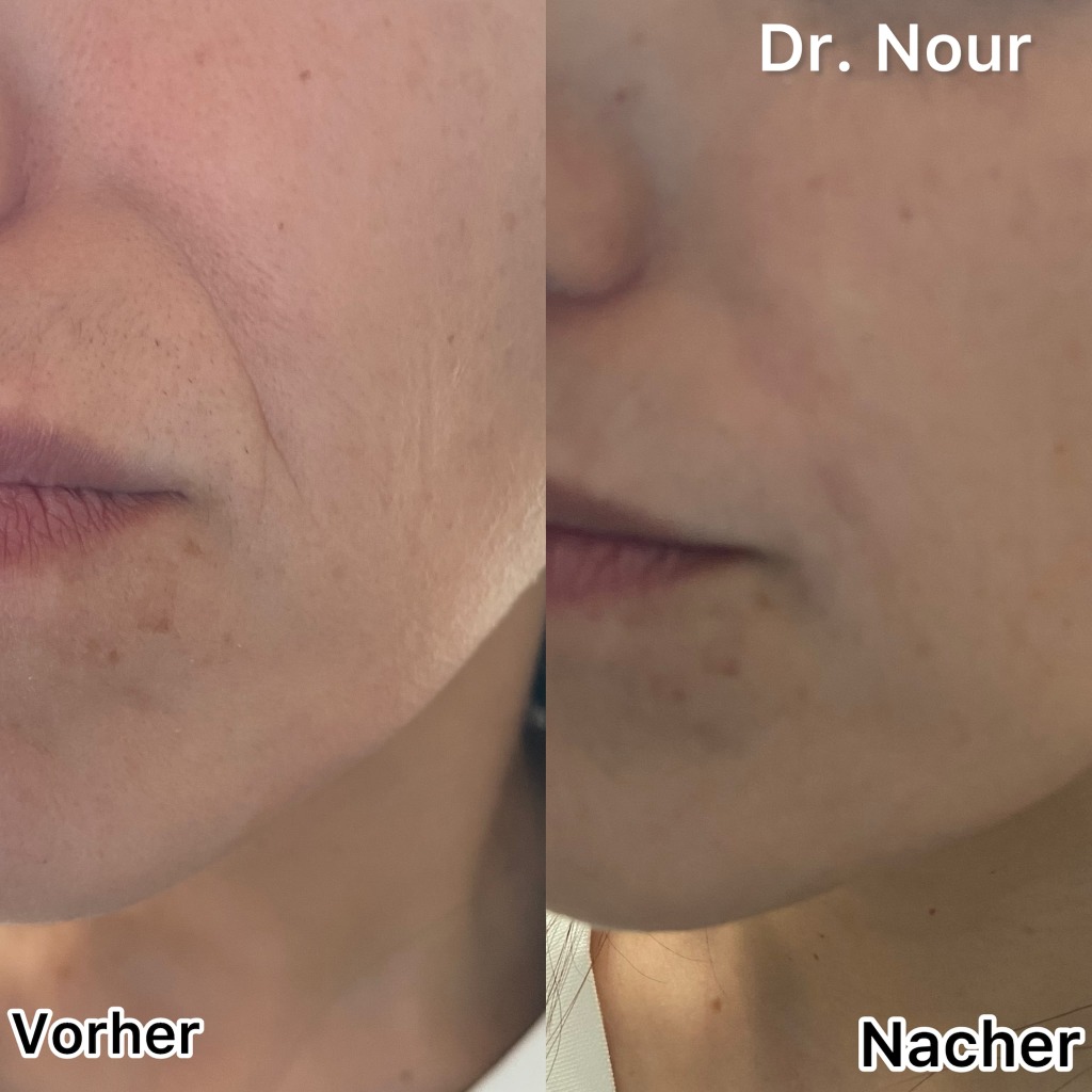 Vorher Nachher — Wangen & Falten, Dr. Nour