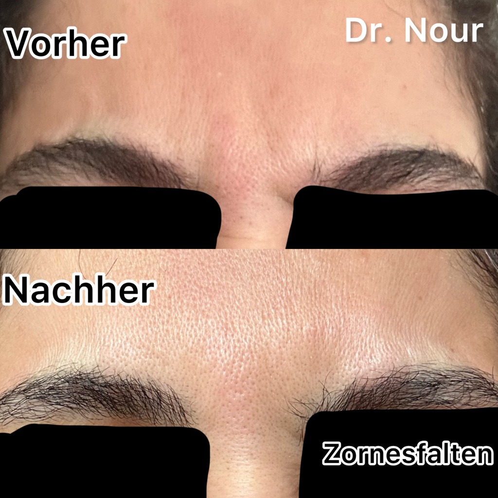 Vorher Nachher — Zornesfalten, Dr. Nour