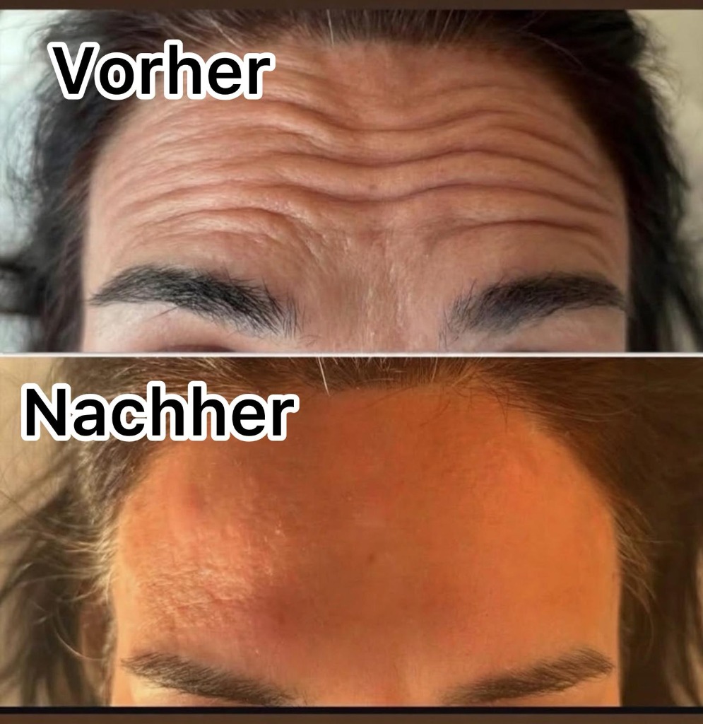 Vorher Nachher — Stirnfalten, Dr. Nour