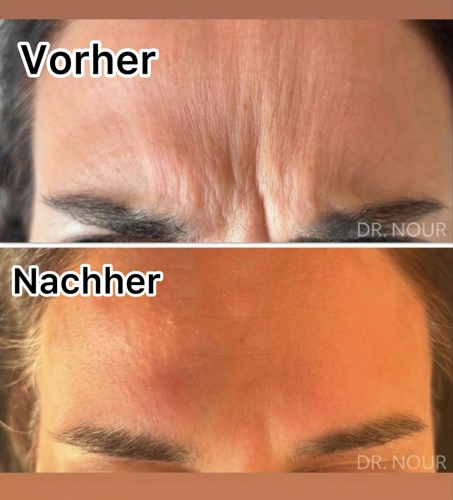 Vorher Nachher — Stirnfalten, Dr. Nour