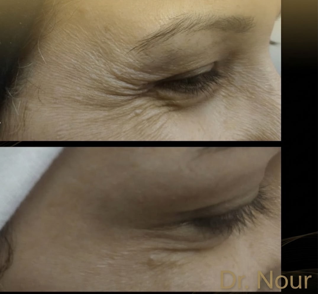 Vorher Nachher — Augenpartie, Dr. Nour