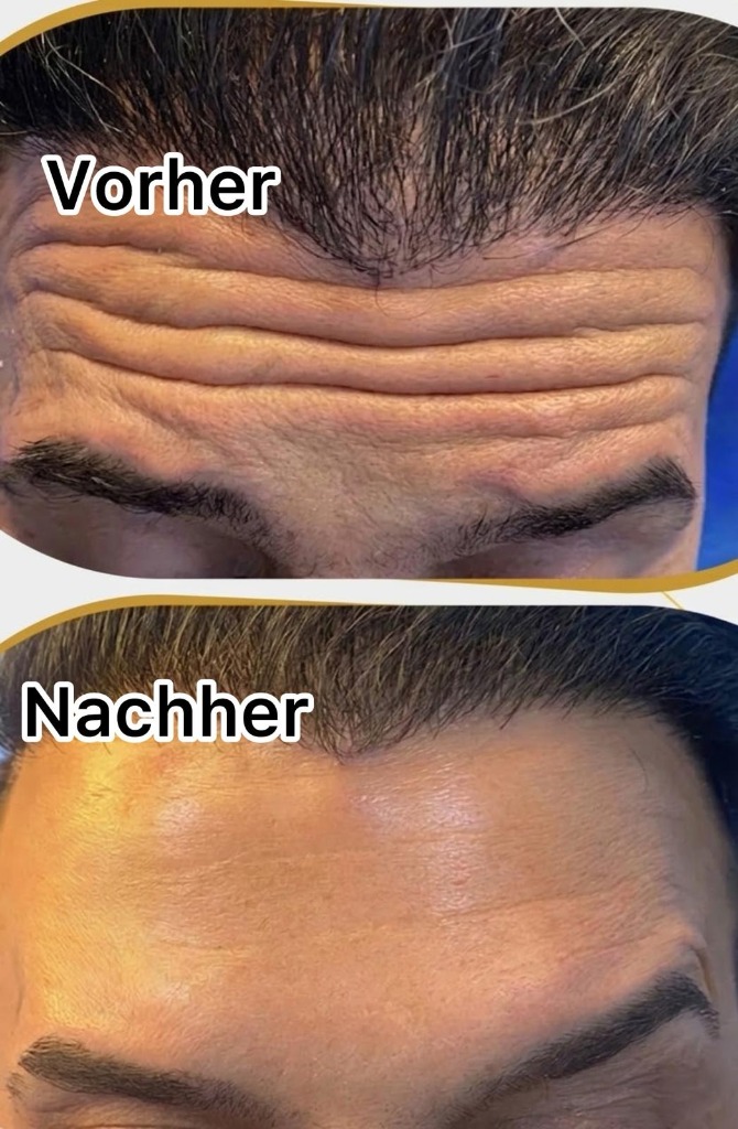 Vorher Nachher — Stirnfalten, Dr. Nour