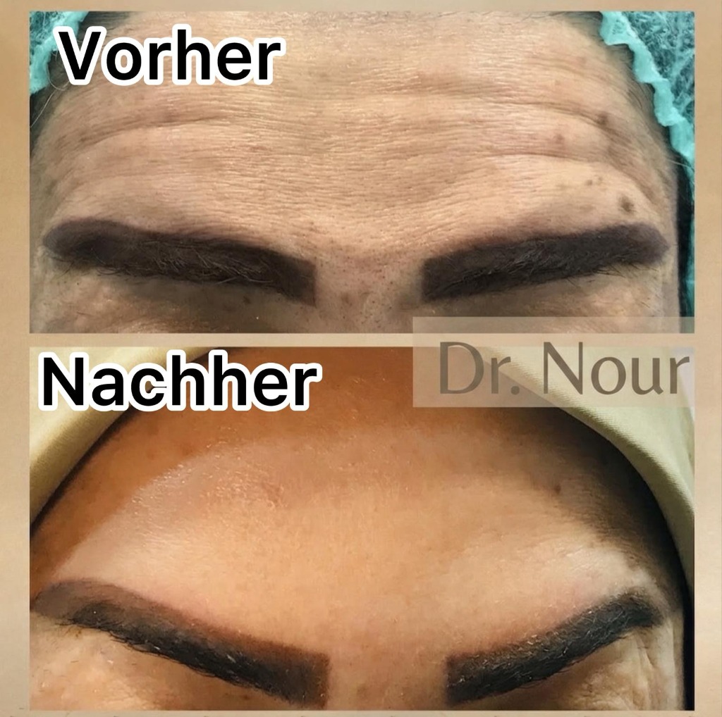 Vorher Nachher — Stirnfalten, Dr. Nour